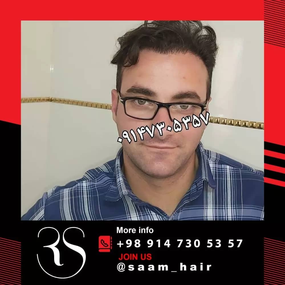 مهم ترین مزایای کاشت مو در کلینیک آلما تبریز