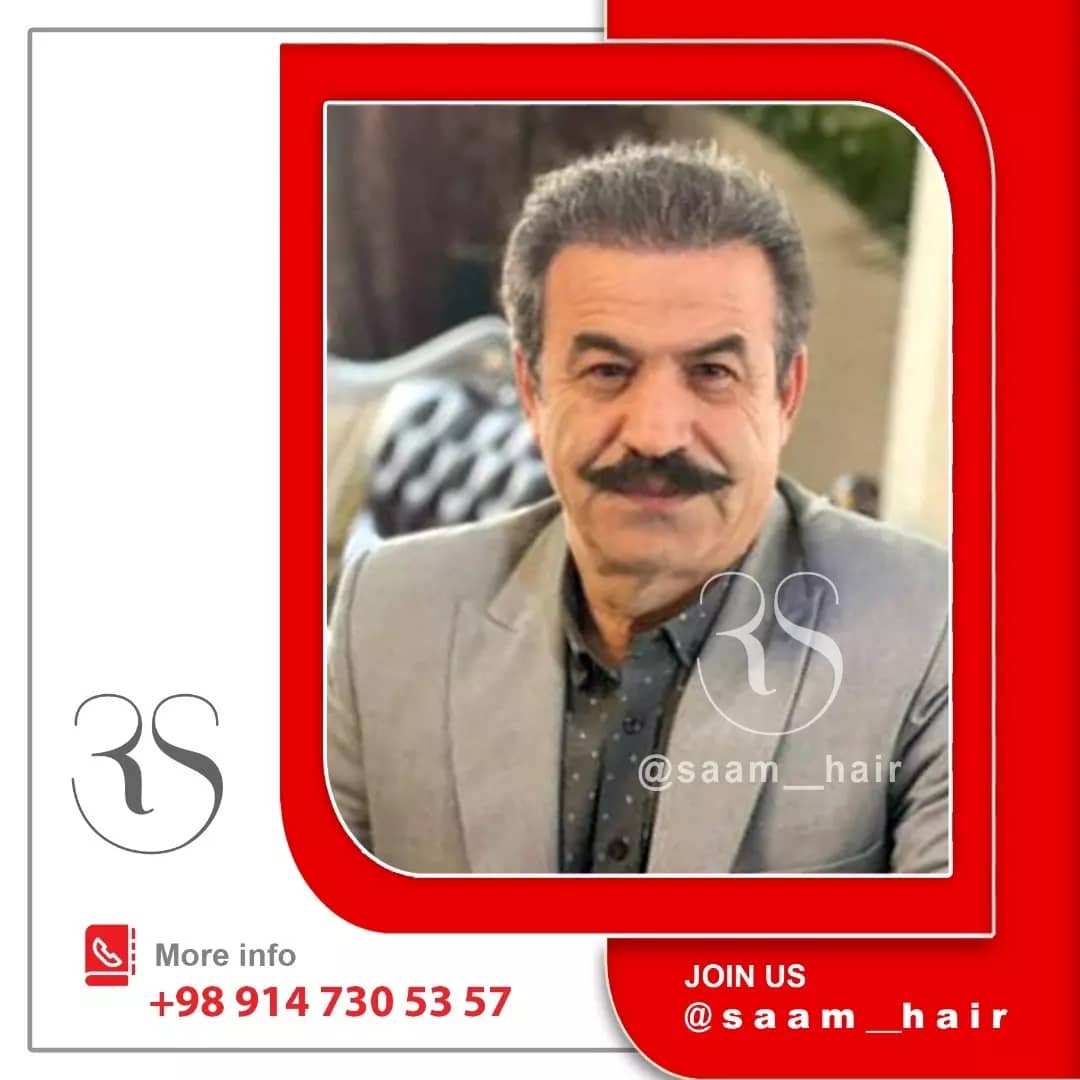 شایع ترین دلایل کاشت مو